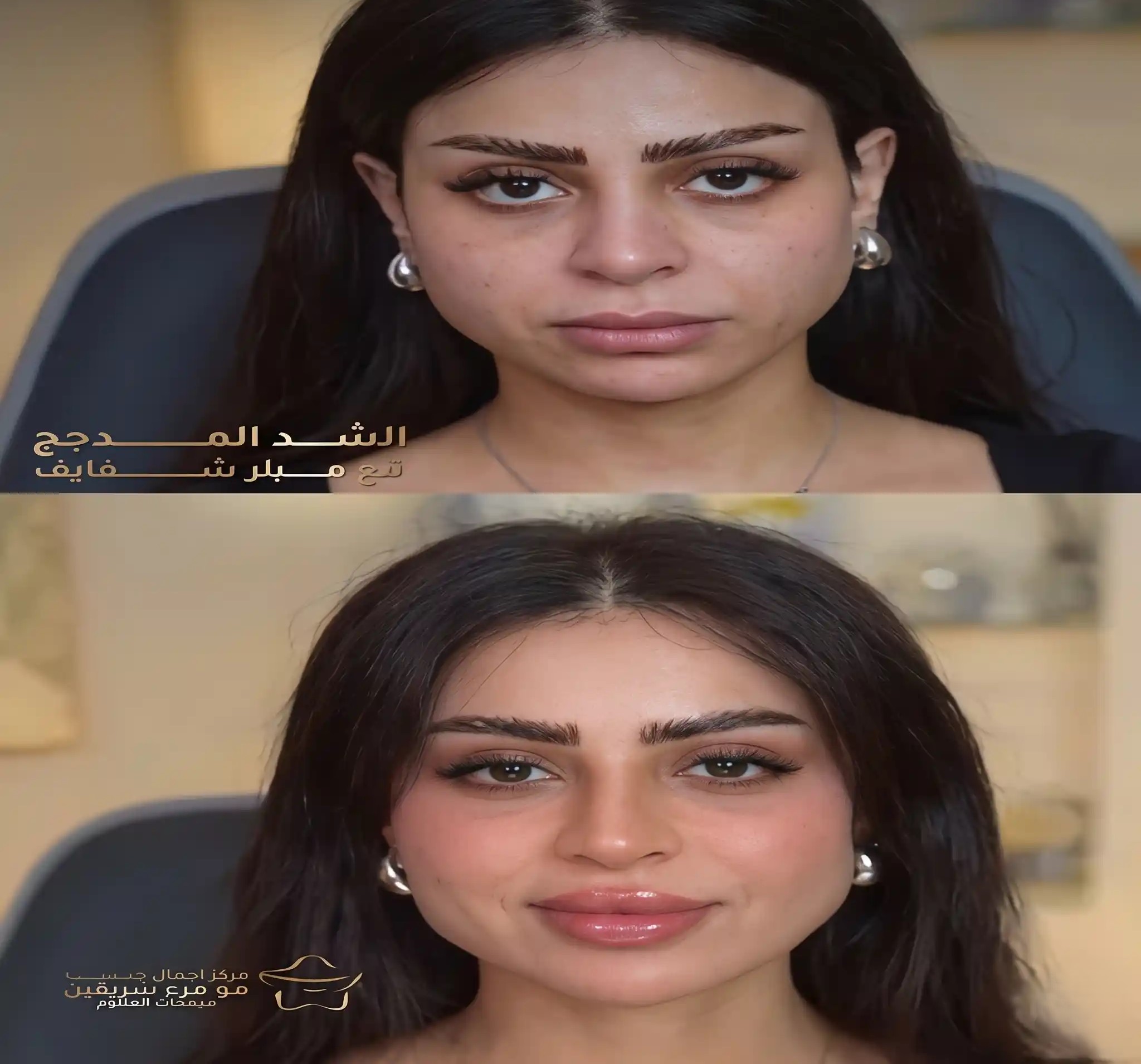 الشد المدمج للوجه